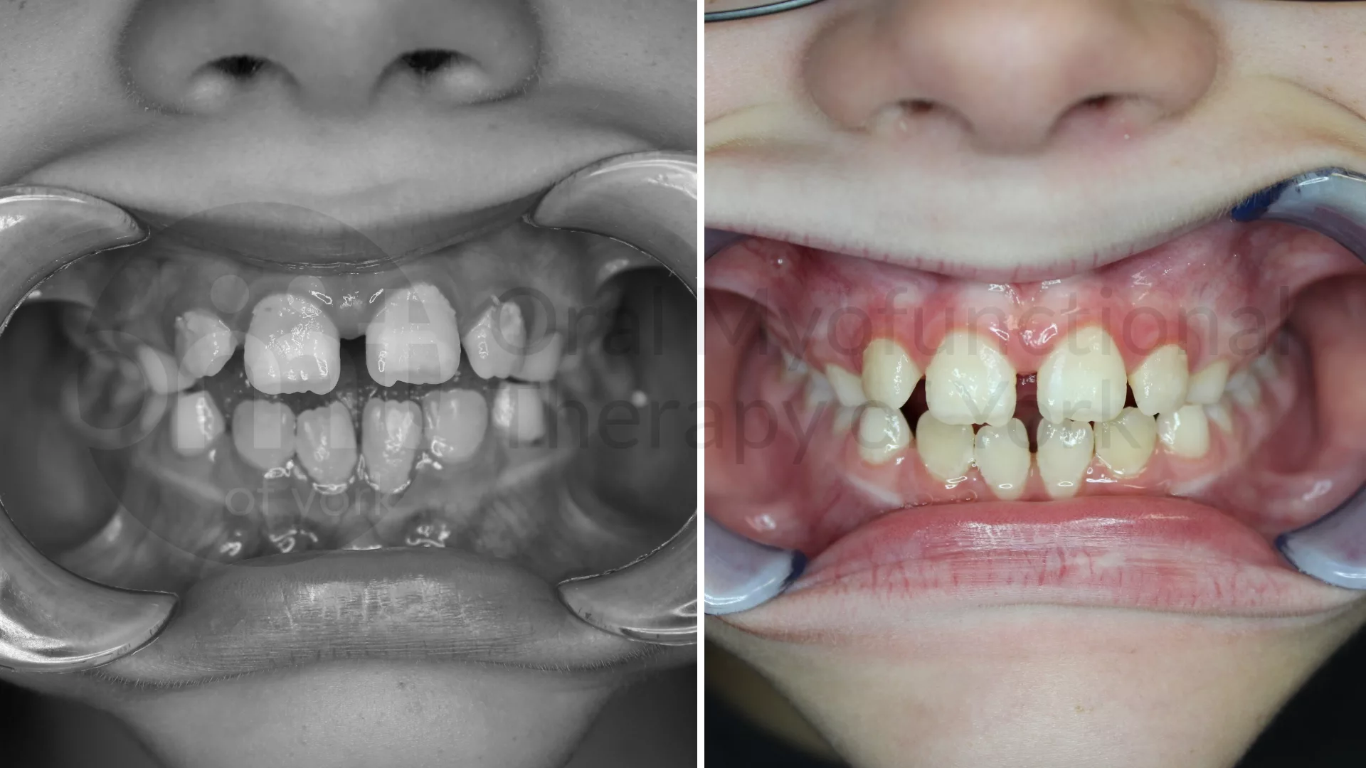 Patient result: Improving lip seal and tongue posture can lead to better alignment of the teeth as well as better health of the gum tissue.