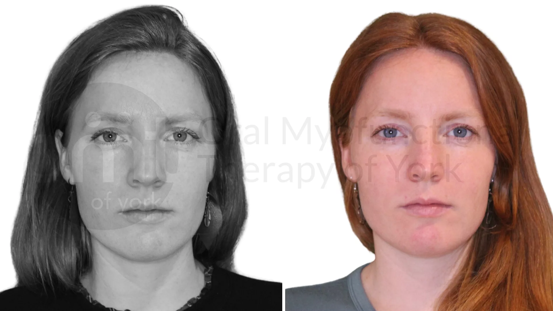 Patient result: Just a few sessions (our mini myo program) and a frenectomy was all it took for this patient to have less jaw pain and less clenching.