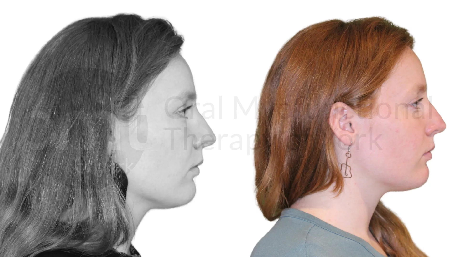 Patient result: Just a few sessions (our mini myo program) and a frenectomy was all it took for this patient to have less jaw pain and less clenching.