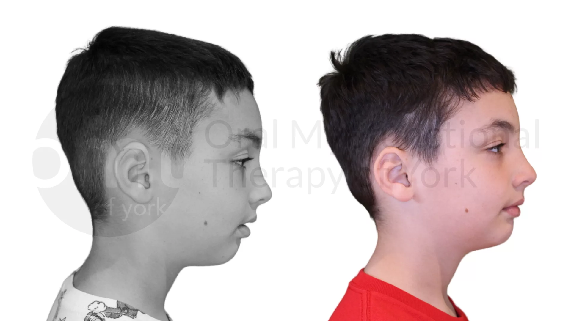 Patient result: Improving oral rest posture and establishing better nasal breathing prior to orthodontic treatment can lead to better orthodontic retention.