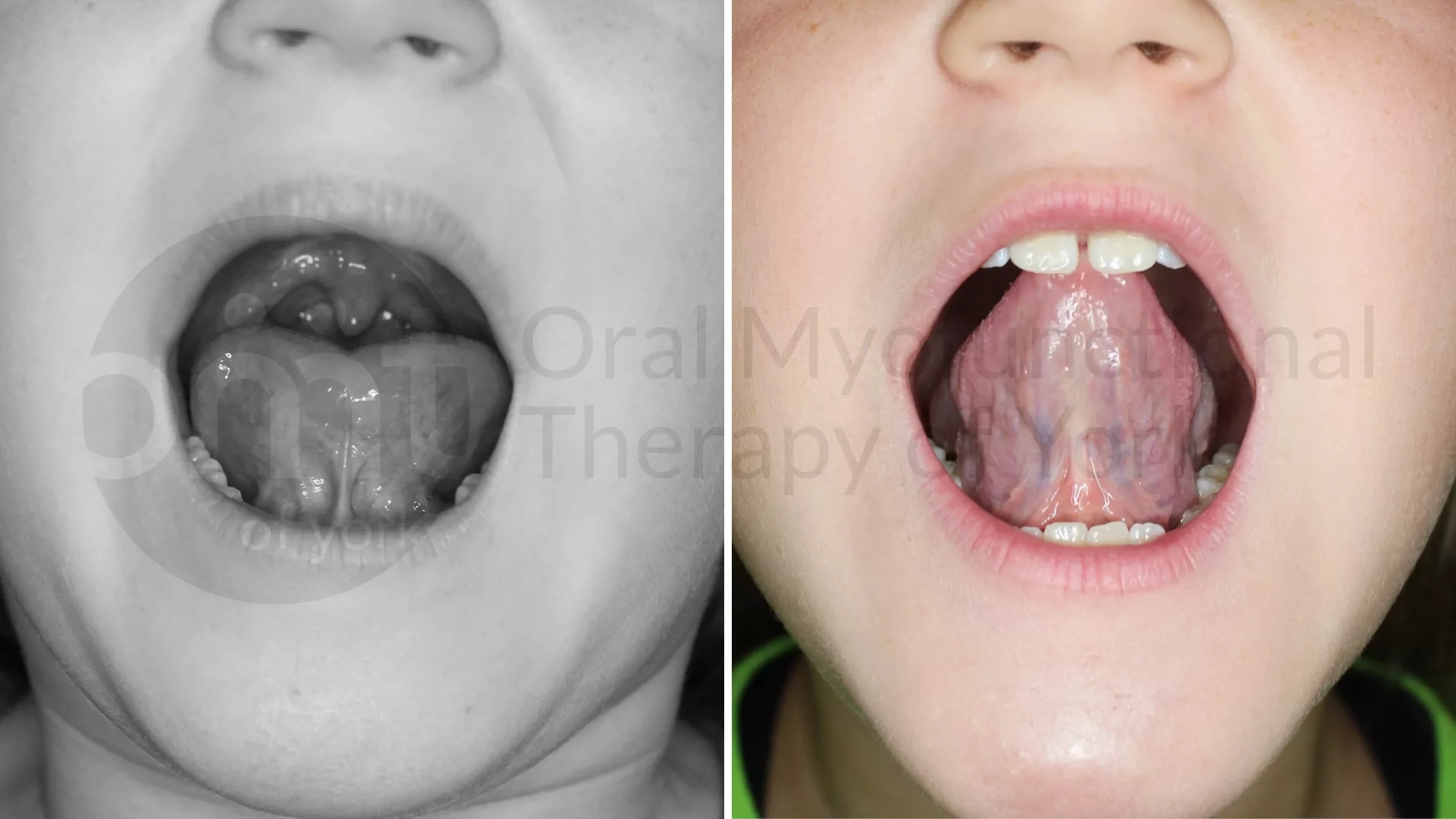 Patient result: Better range of motion of the tongue from a frenectomy and therapy can lead to better growth patterns, better chewing/swallowing patterns…