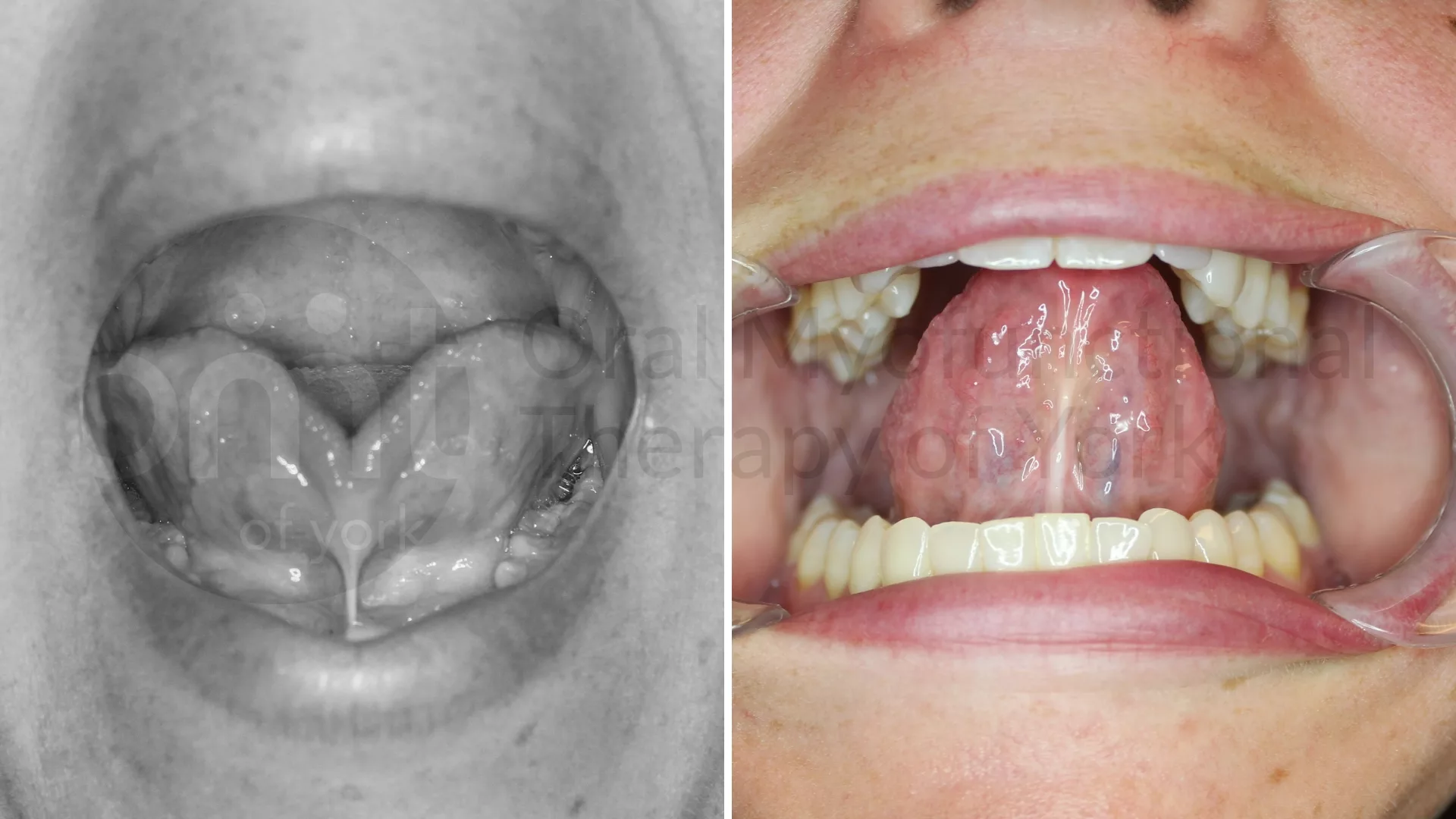 Patient result: This severe tongue tie was contributing to poor oral rest posture, forward head posture and poor chewing/swallowing patterns. The patient…