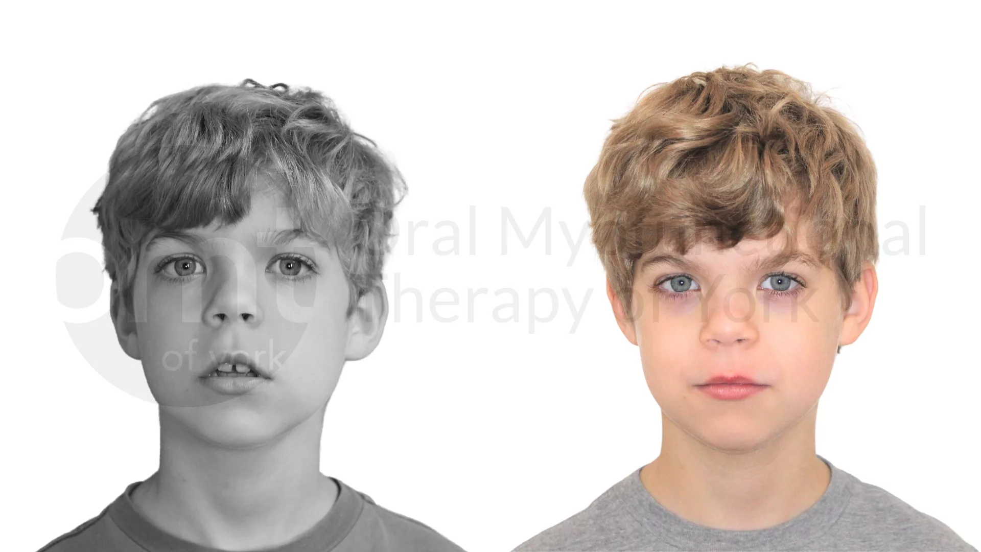 Patient result: OMT when combined with good nasal hygiene can drastically improve breathing patterns, craniofacial growth and overall health.