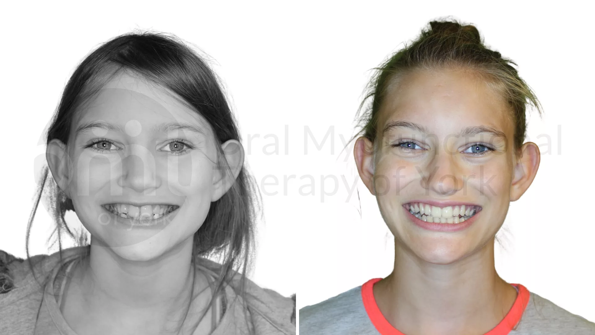 Patient result: OMT and a frenectomy combined with a growth guidance appliance led to amazing changes for this patient.
