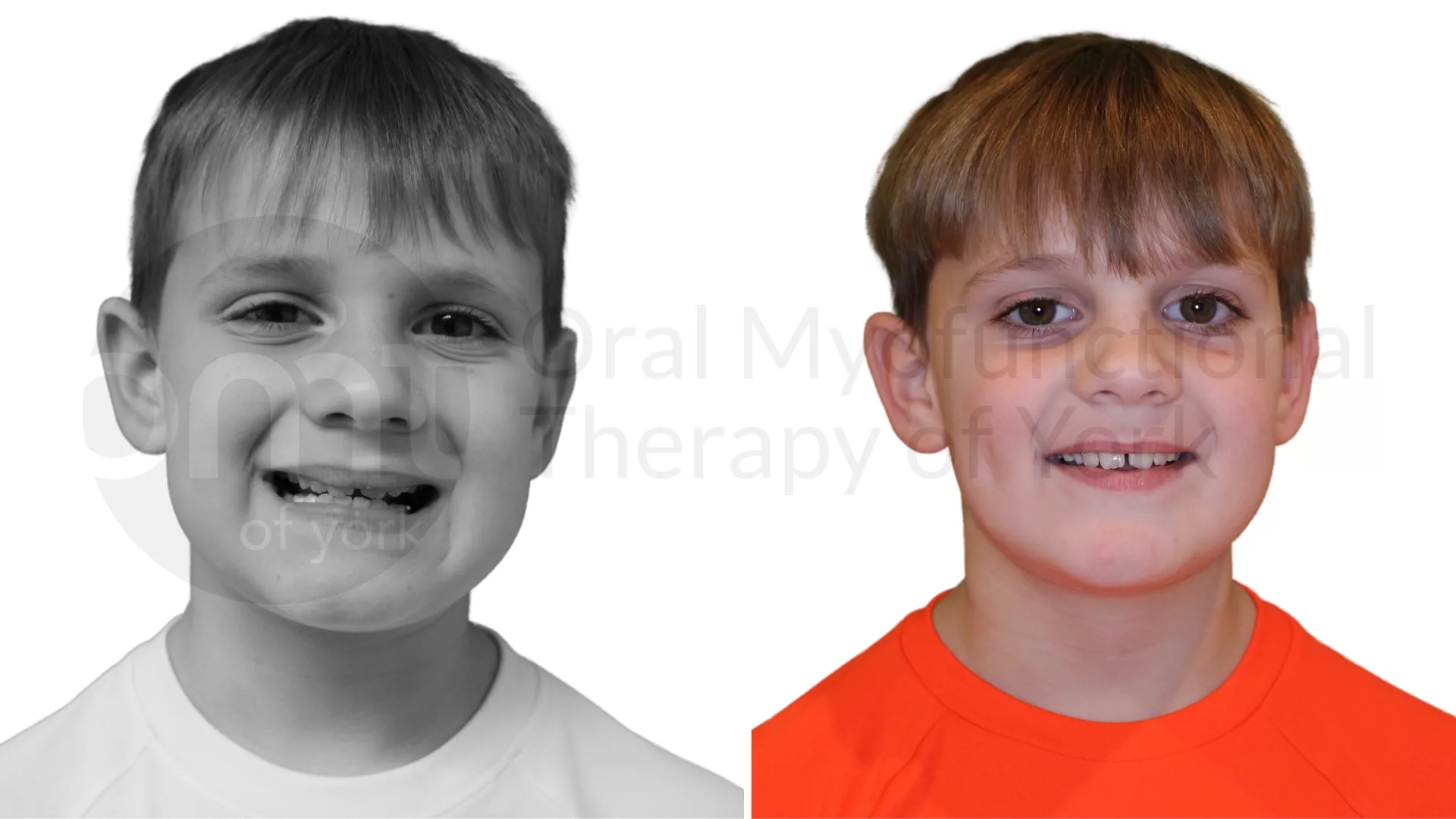 Patient result: Jaw position and jaw growth rely on good oral rest posture and good range of motion of the tongue.