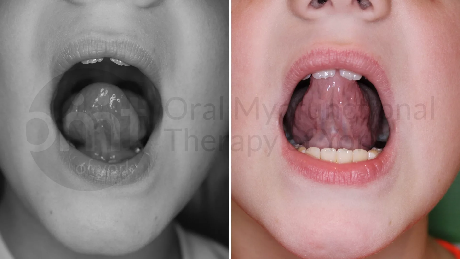 Patient result: Tongue restrictions that are often deemed "normal" by multiple medical practitioners can have a significant impact on growth and overall…