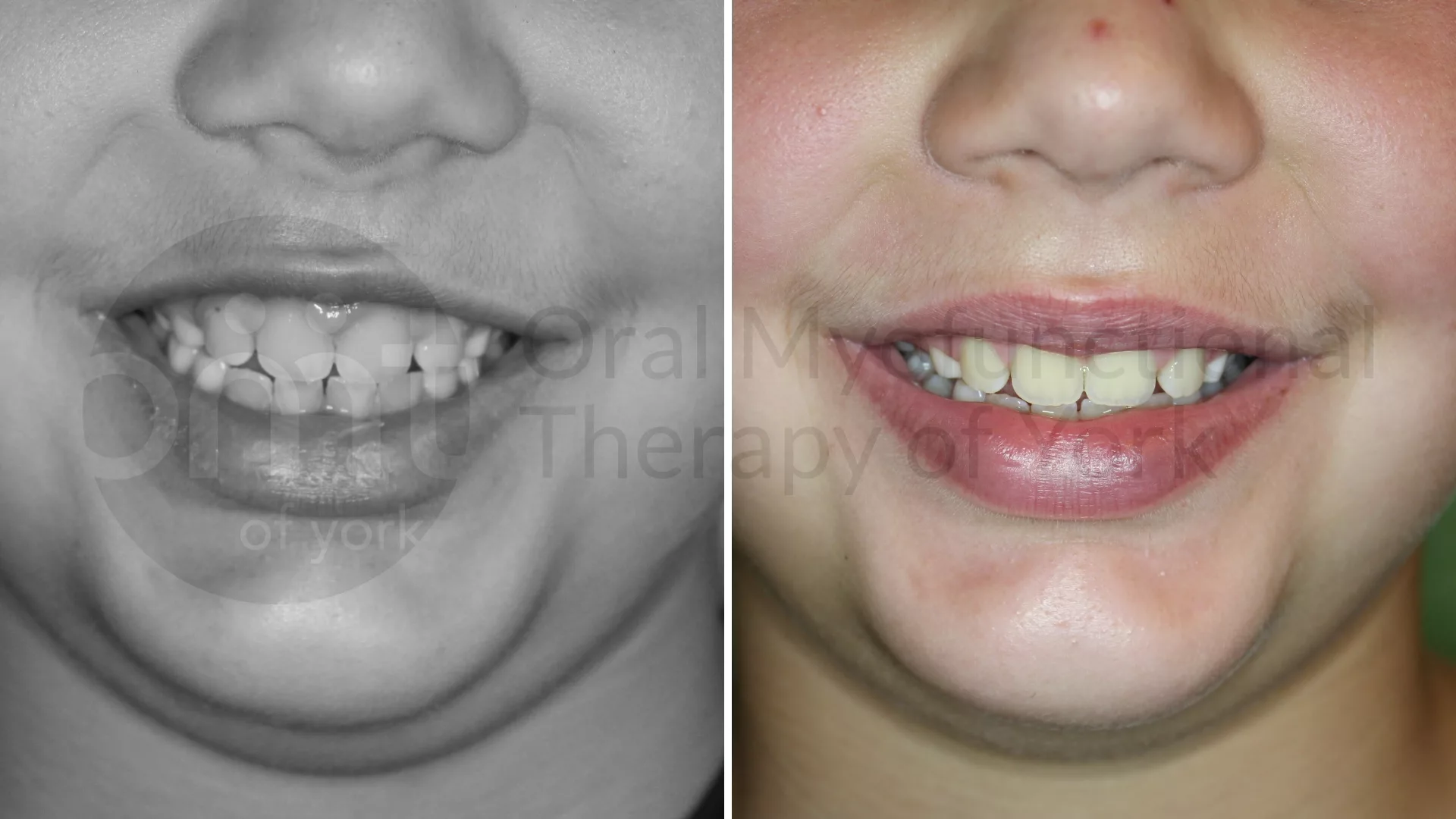 Patient result: When the tongue rests low in the mouth, the facial muscles must compensate. This patient had improvements in facial muscle function and i…