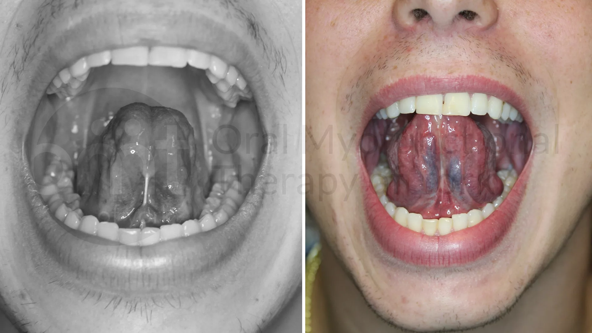 Patient result: Tongue tie release and 3 months of OMT.