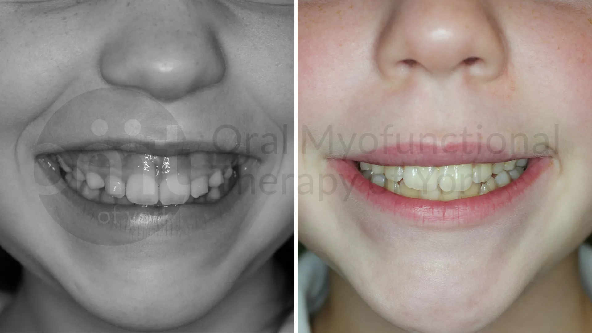 Patient result: This patient had an upper lip tie released PRIOR to seeing us for therapy. Changes shown here are due to OMT to help rehabilitate the ora…