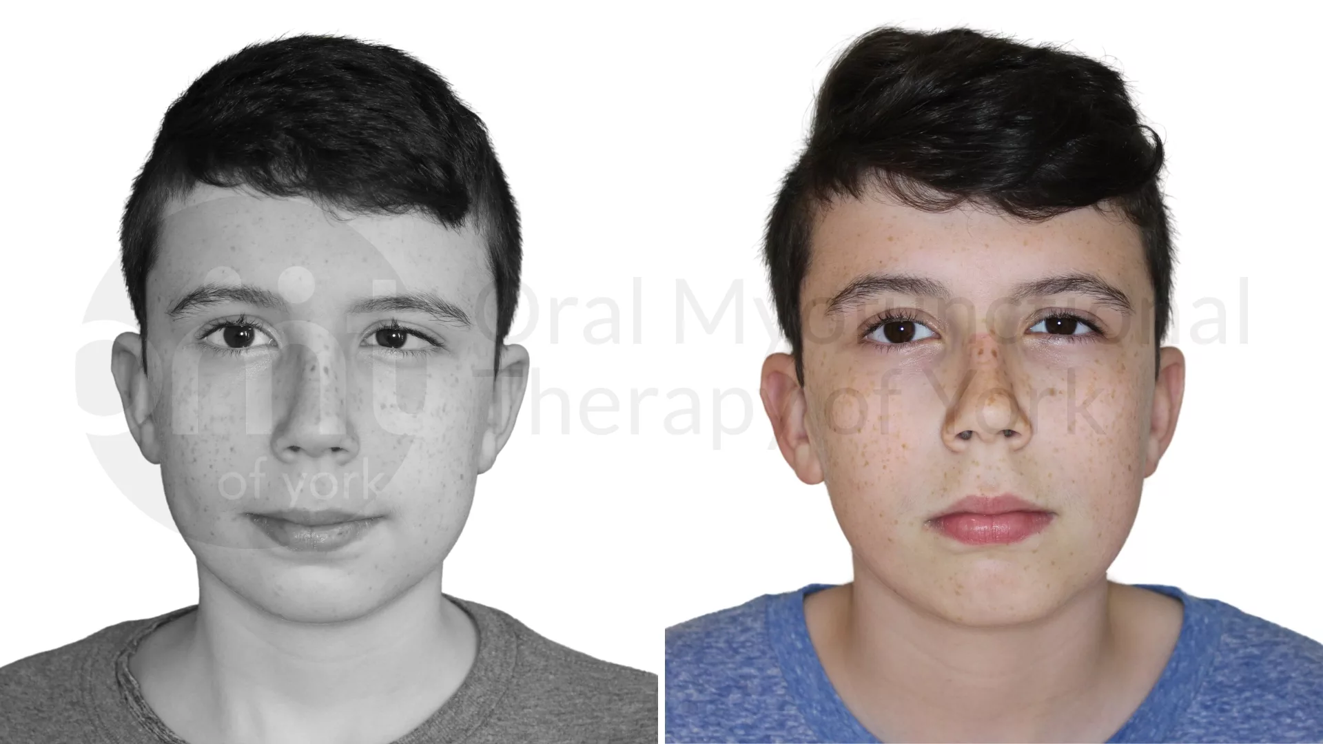 Patient result: Severe tongue ties are often linked to fascial strain in other areas of the body. The decrease in fascial strain in the eye was a happy s…