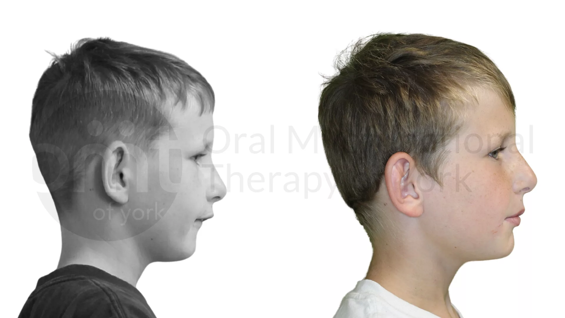 Patient result: Nine months of OMT and a tongue tie release led to improved positioning of the lower jaw.