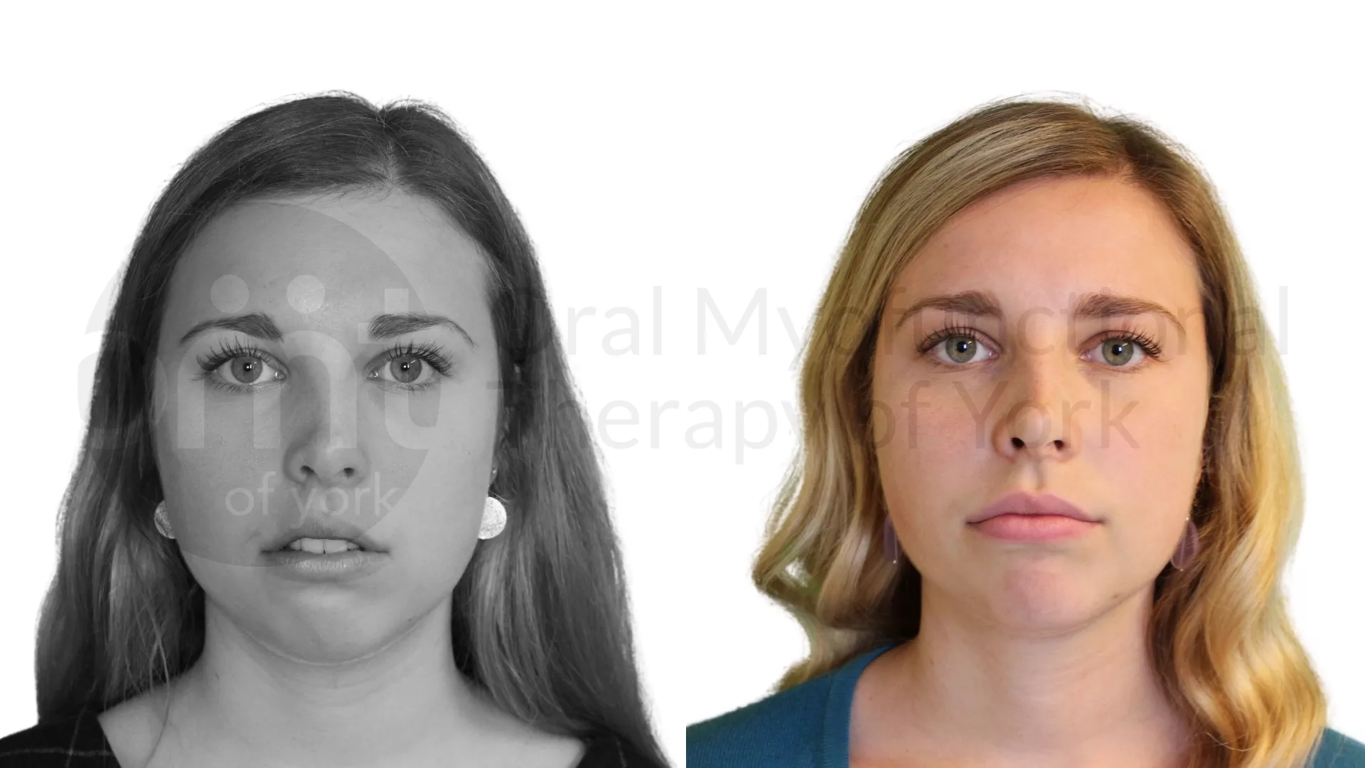 Patient result: Facial appearance can improve when addressing poor lip seal.
