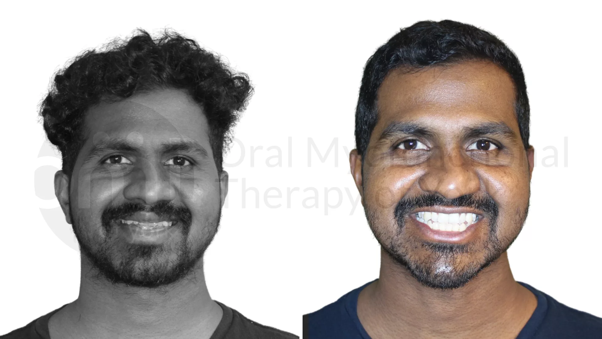 Patient result: Improvements in tongue posture, facial muscle function and jaw position at rest led to fantastic changes in appearance and function for t…