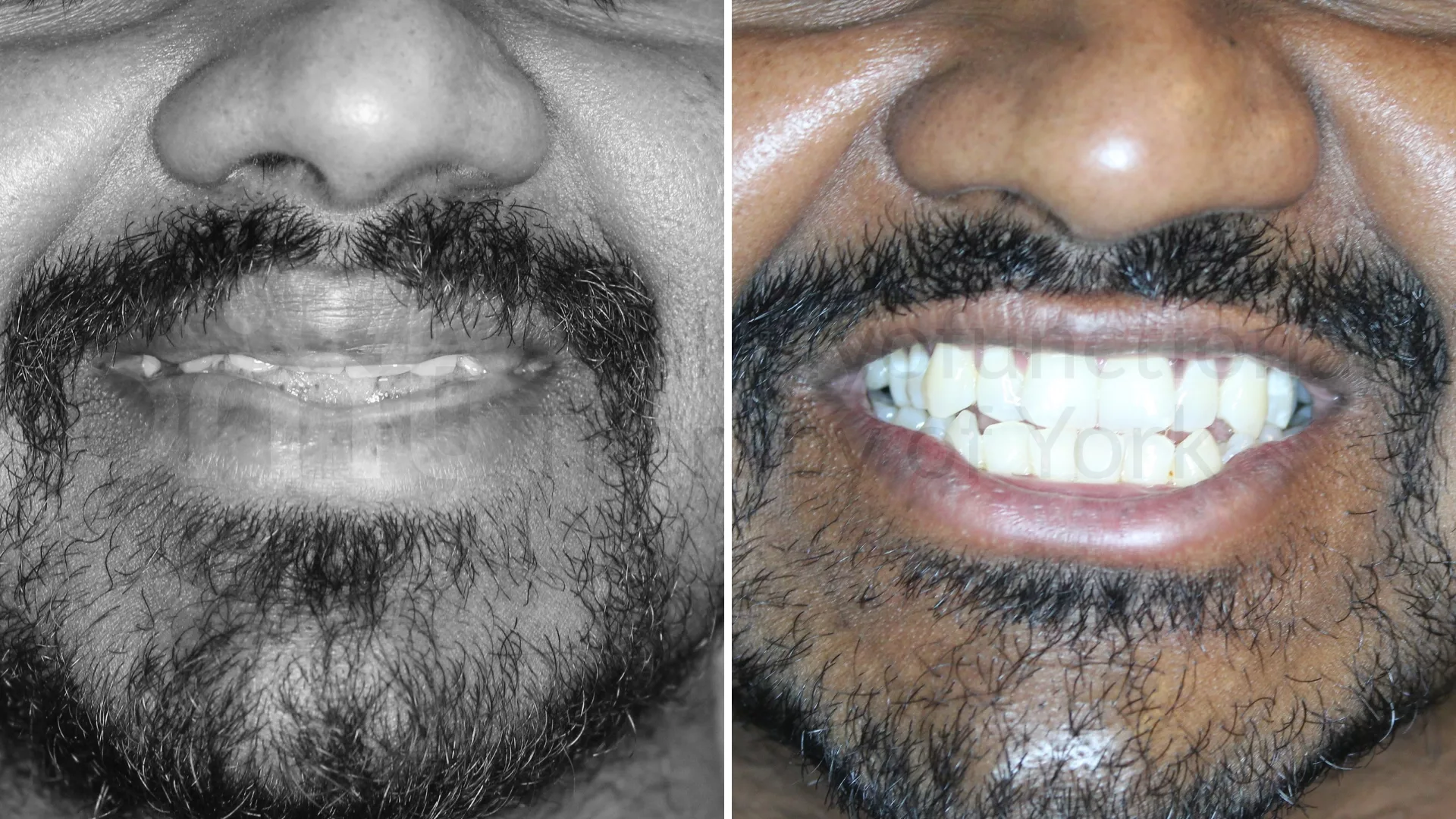 Patient result: Improvements in tongue posture, facial muscle function and jaw position at rest led to fantastic changes in appearance and function for t…