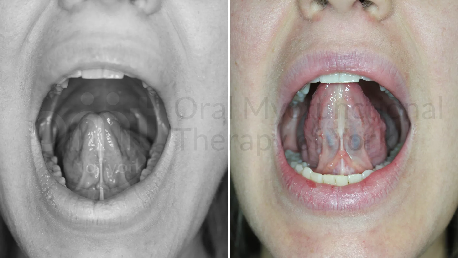 Patient result: This patient (a Speech and Language Pathologist) was incredibly fatigued after therapy with her own patients. Addressing her own tongue t…