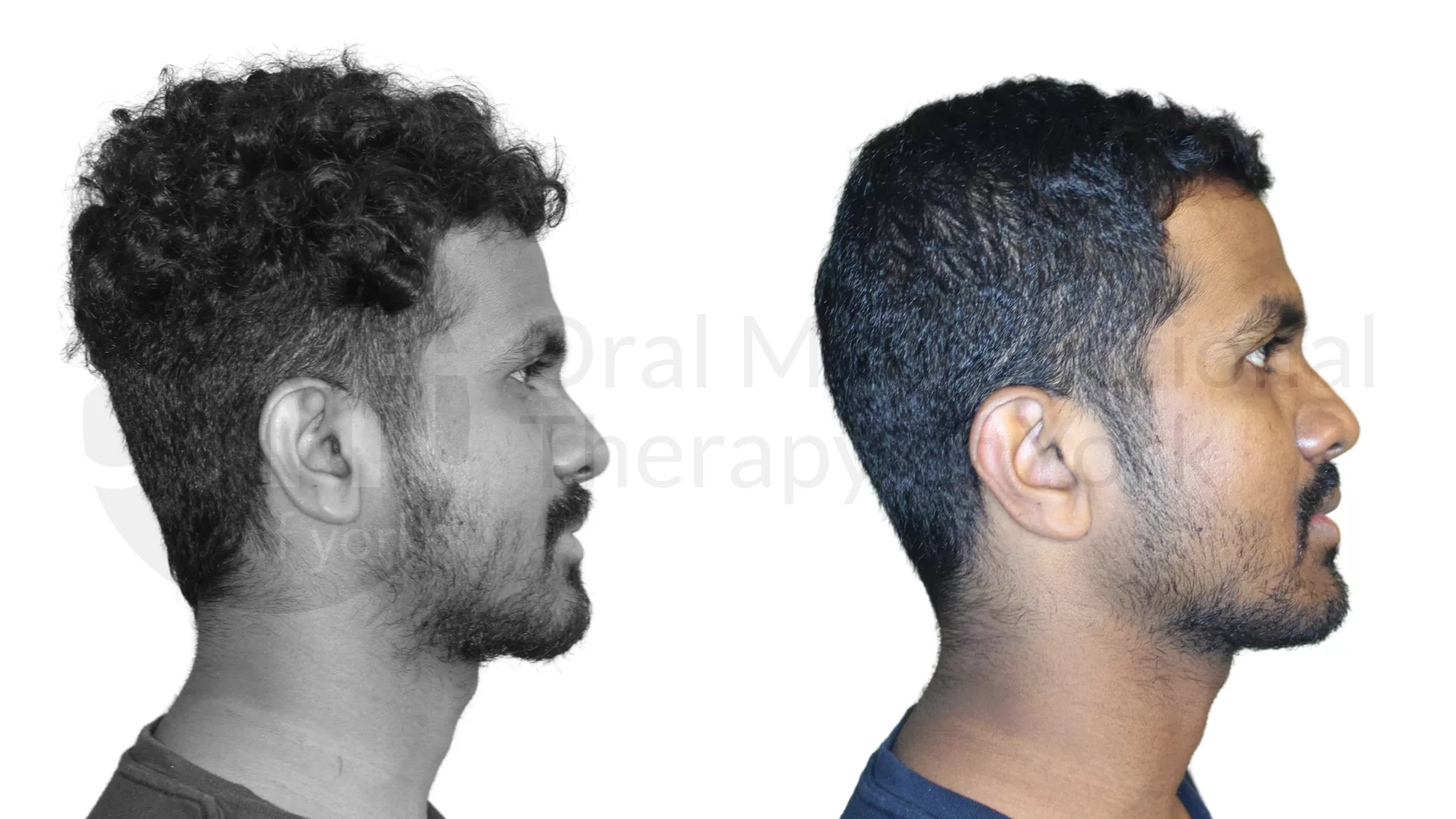 Patient result: Improvements in tongue posture, facial muscle function and jaw position at rest led to fantastic changes in appearance and function for t…