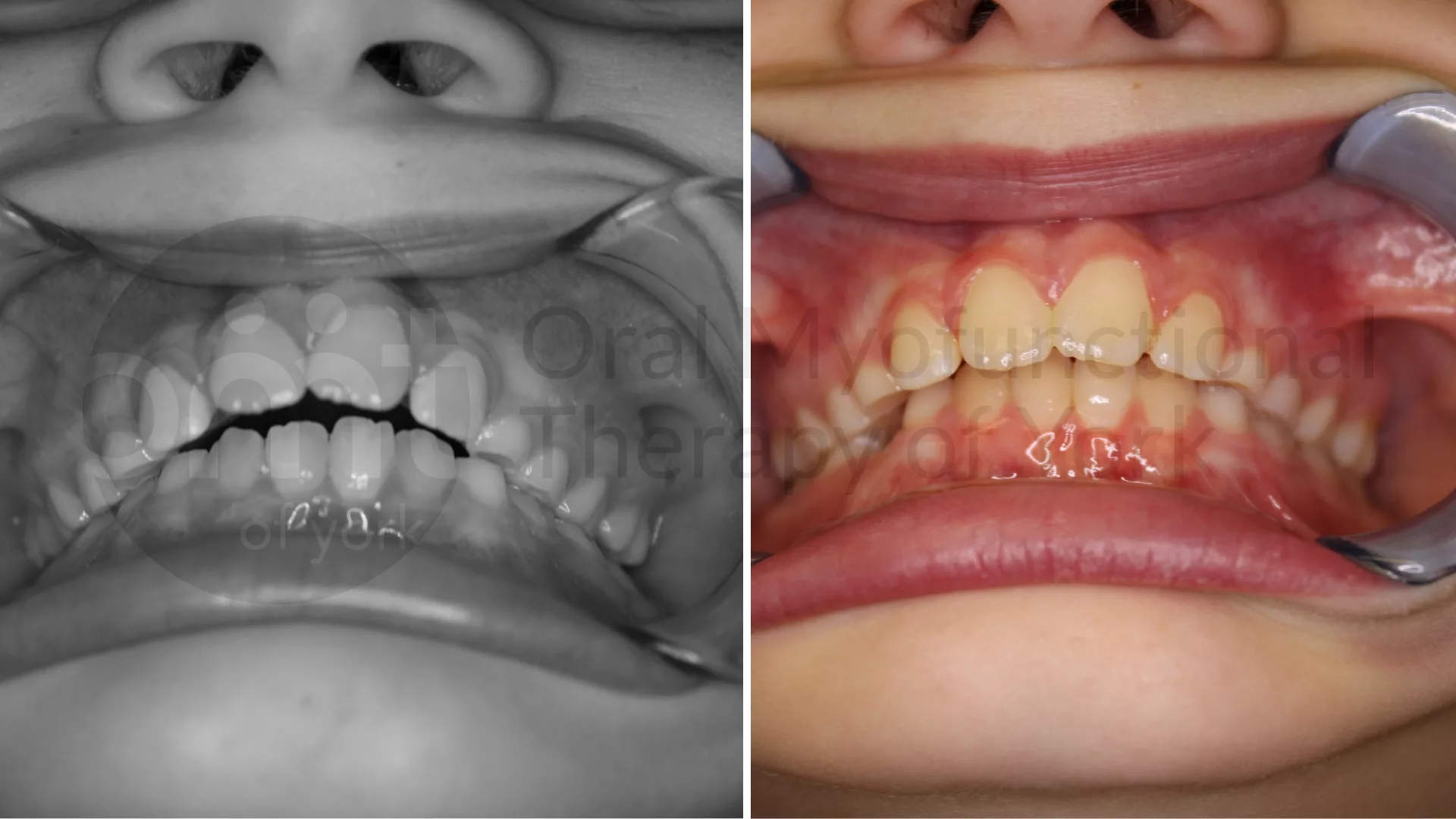 Patient result: Eliminating oral habits such as thumb sucking can lead to better alignment of the teeth and jaws.