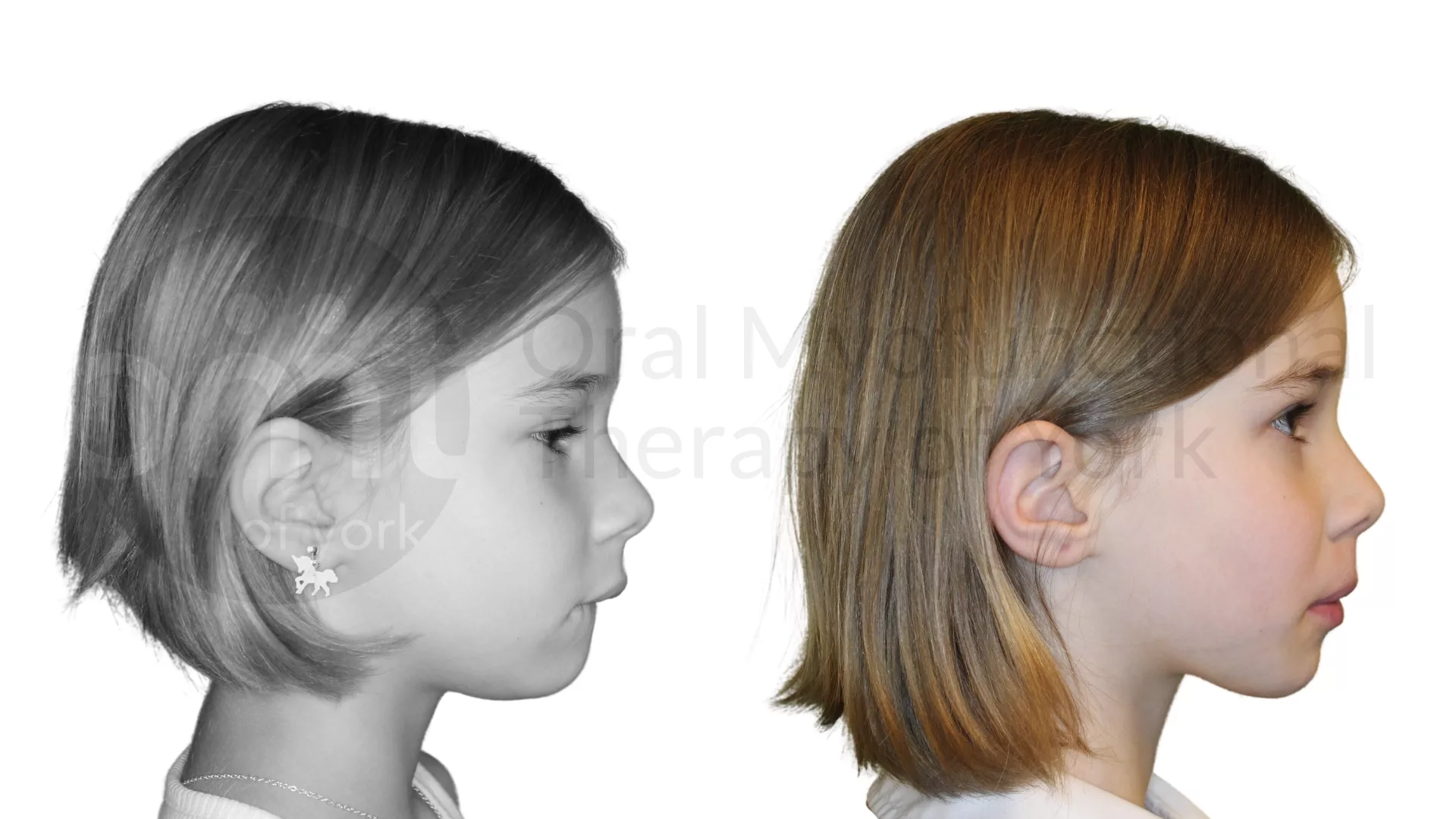 Patient result: Thumb sucking elimination, therapy and a frenectomy leading to improved growth patterns.
