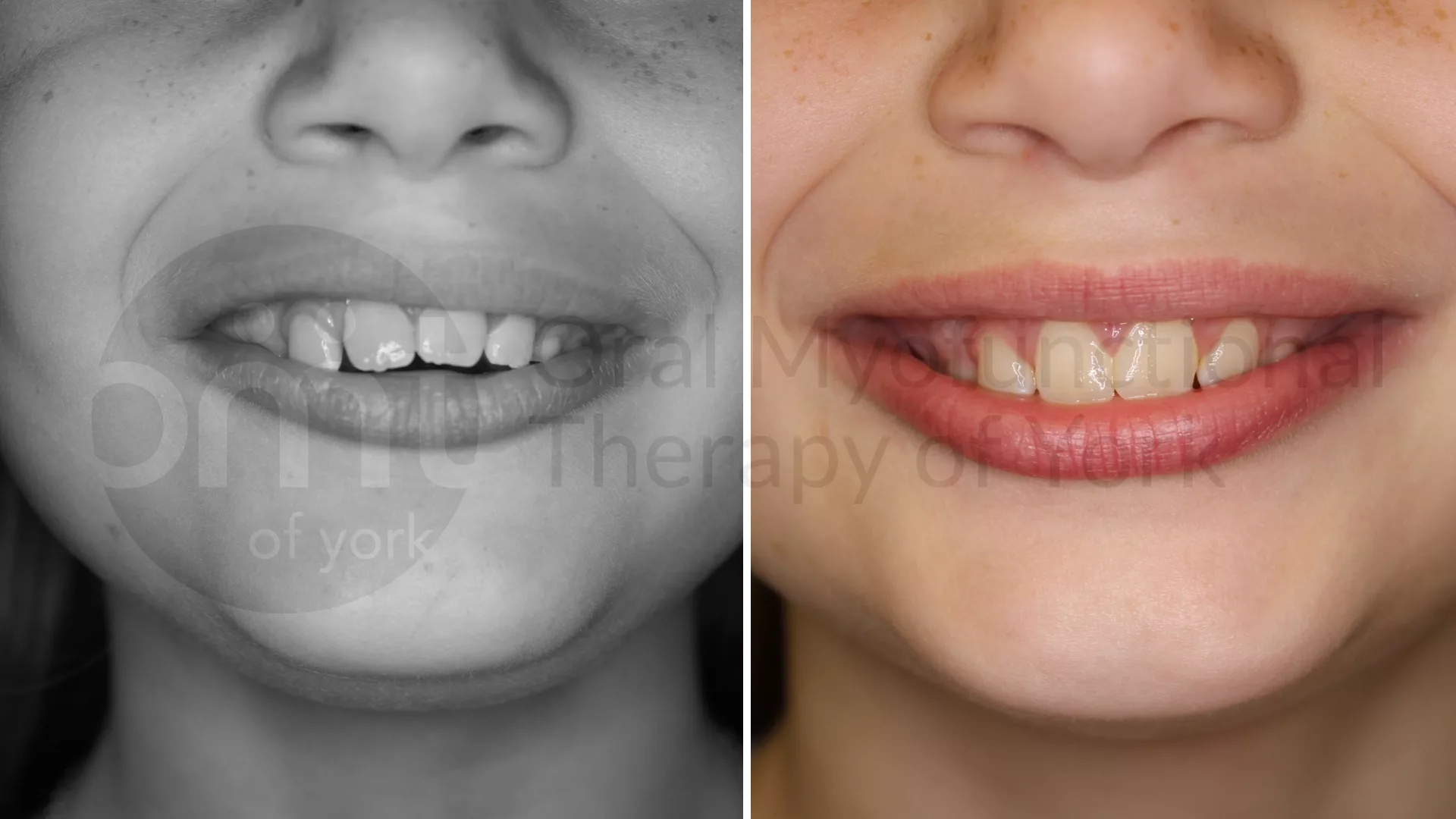 Patient result: Eliminating oral habits such as thumb sucking can lead to better alignment of the teeth and jaws.