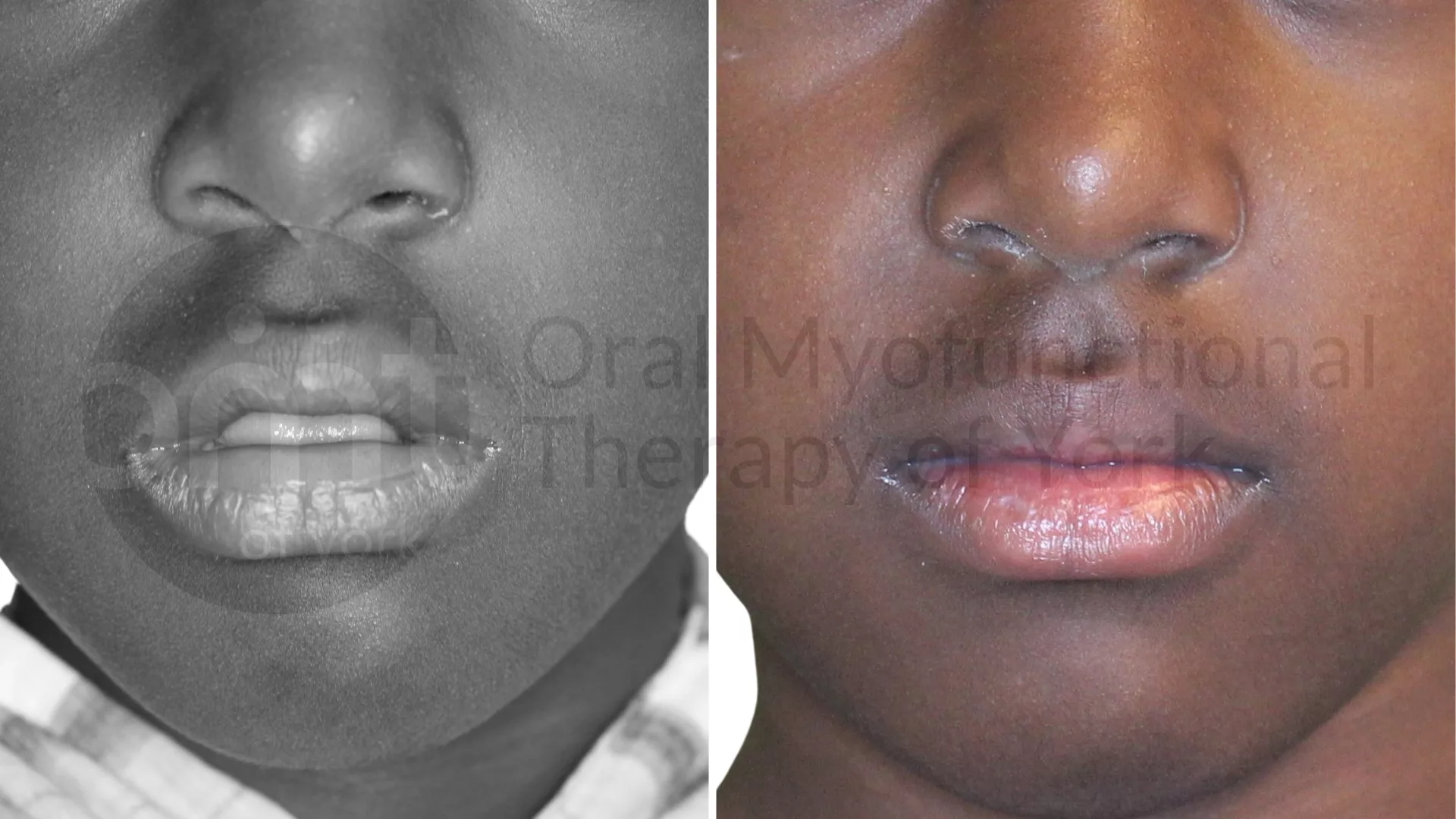 Patient result: Improvement in the rest posture of the tongue and lips from OMT.