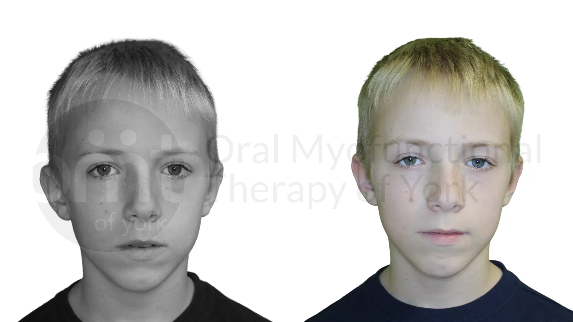 Patient result: Chronic airway issues such as allergies are the most common cause of Orofacial Myofunctional Disorders. Combining OMT with treatment from…