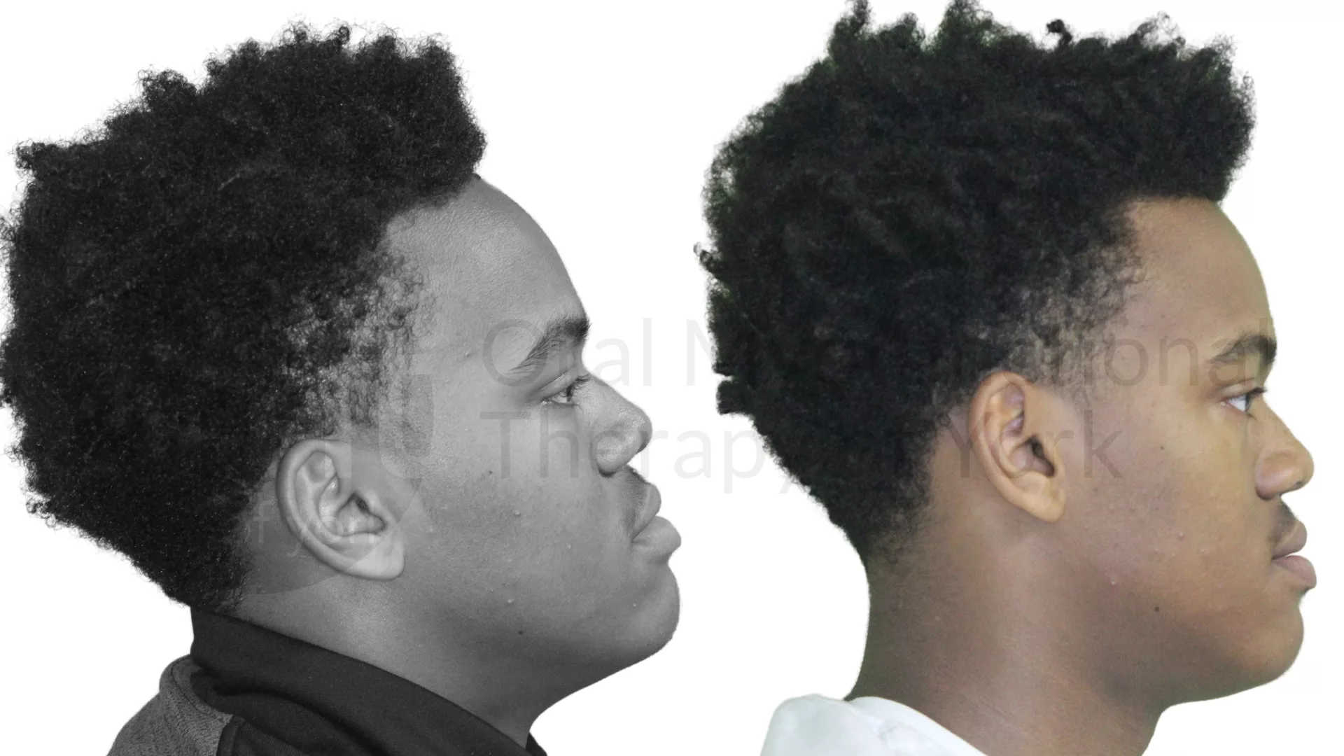 Patient result: Better tongue posture leads to better head posture and better breathing patterns.