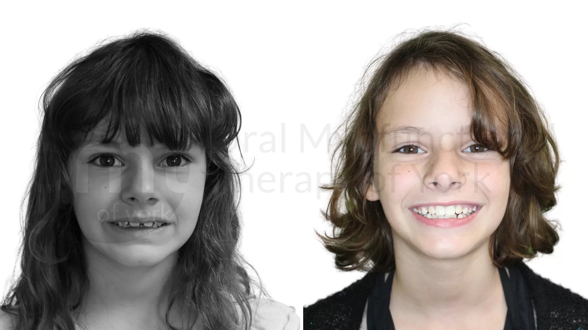 Patient result: Four months of therapy followed by Phase 1 orthodontic expansion led to phenomenal changes in less than a year for this patient.