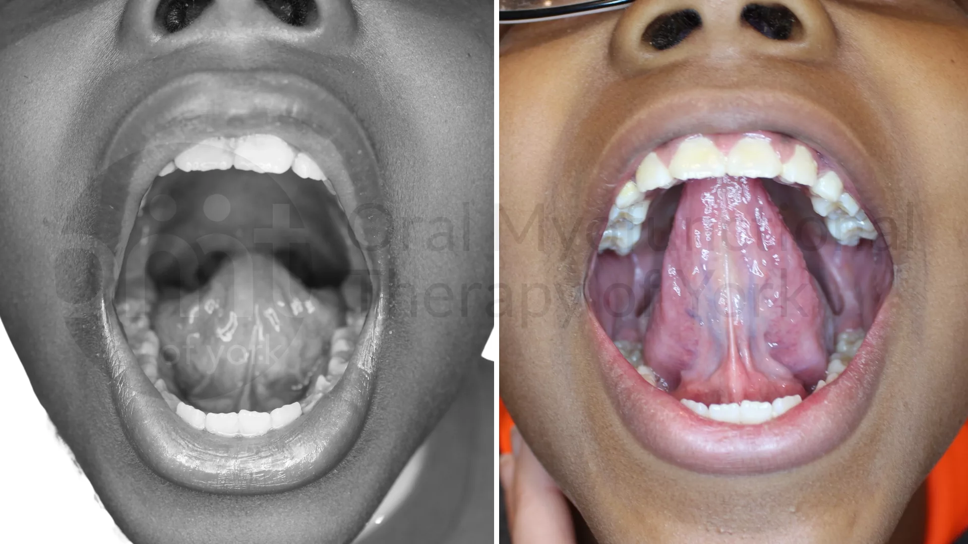 Patient result: We can improve the range of motion and function of the tongue WITHOUT a frenectomy (tongue tie release) in many of the cases that we see.…