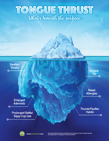 Tongue Thrust Educational Poster (16″ × 20″)